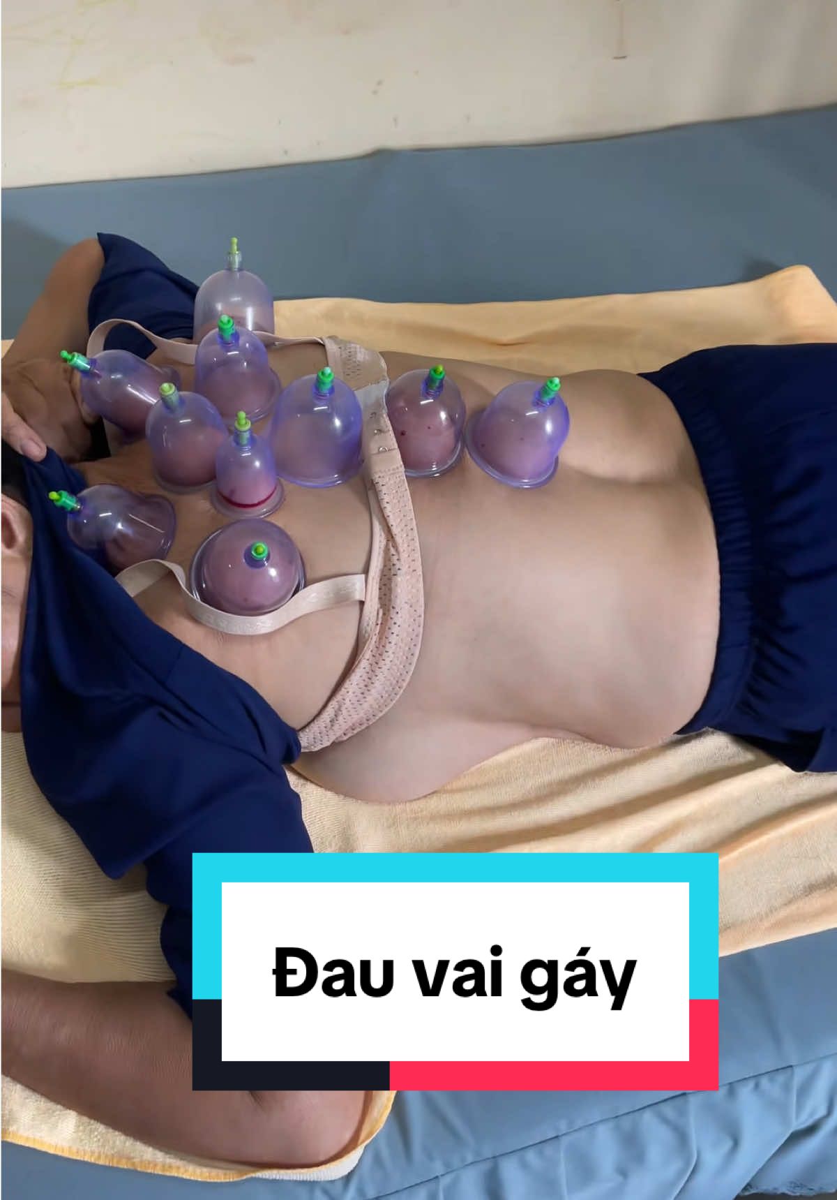 Trị liệu vai gáy #đauvaigáy 