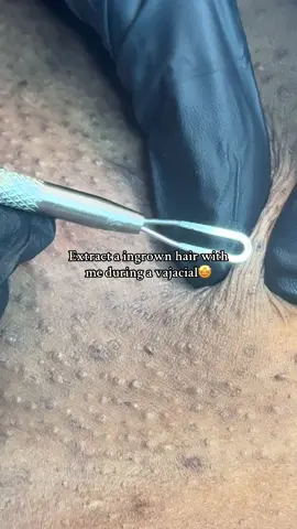 just watch my mf video! #extractions #baltimorewaxer 