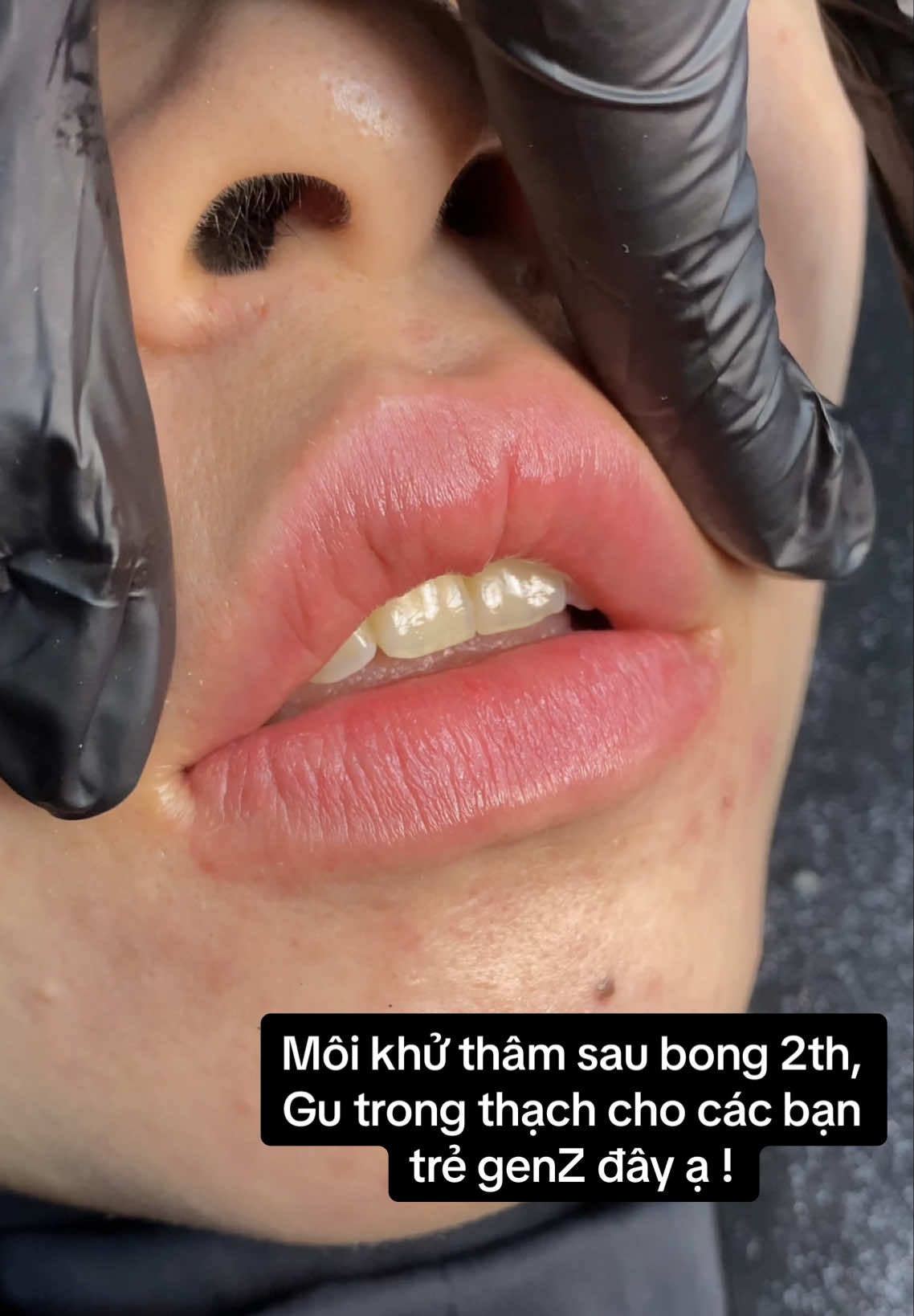 Môi khử thâm sau bong 2 tháng, Màu môi tươi tắn và trong veo như thạch cho các bạn trẻ genZ đây ạ ! Môi hết thâm trong trẻo giúp mình xinh hơn , son môi son dưỡng lên đúng tone màu xinh xắn, trong trẻo mà ko bị xỉn tối màu Môi em Ngà nặn có cùng Gu nàng khum nè 💋 #LearnOnTikTok  #lamdep #xuhuong #khuthammoi #phunmoitunhien 