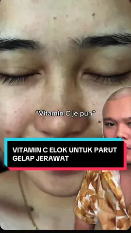 10% pure vitamin c memang dikaji dose yang selamat untuk kulit dan sesuai untuk pudarkan parut hitam jerawat, dark spot… Tu yang aku recommend korang 10% pure vitamin c brightening serum @Skintific.my , jgn lupa pakai sunscreen lepas tu… Konsistent, akan pudar parut korang tu… parut gelap bukan parut berlekuk yeee… #dr1share 