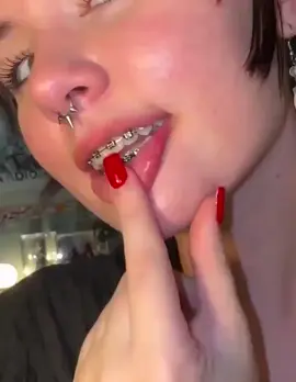 #fyp #xyzbca #bop #braces #tongue 