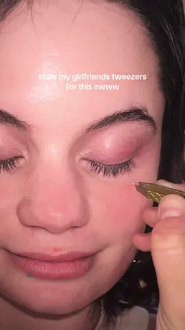 foIIow meee if your new here - the craziest pimple 