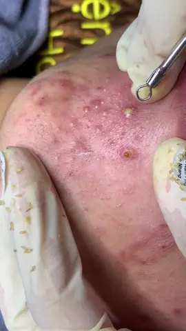 Nhột#chamsocdamun#chamsocdaseo#chamsocdanam#tanbinh#Lqspa&academy