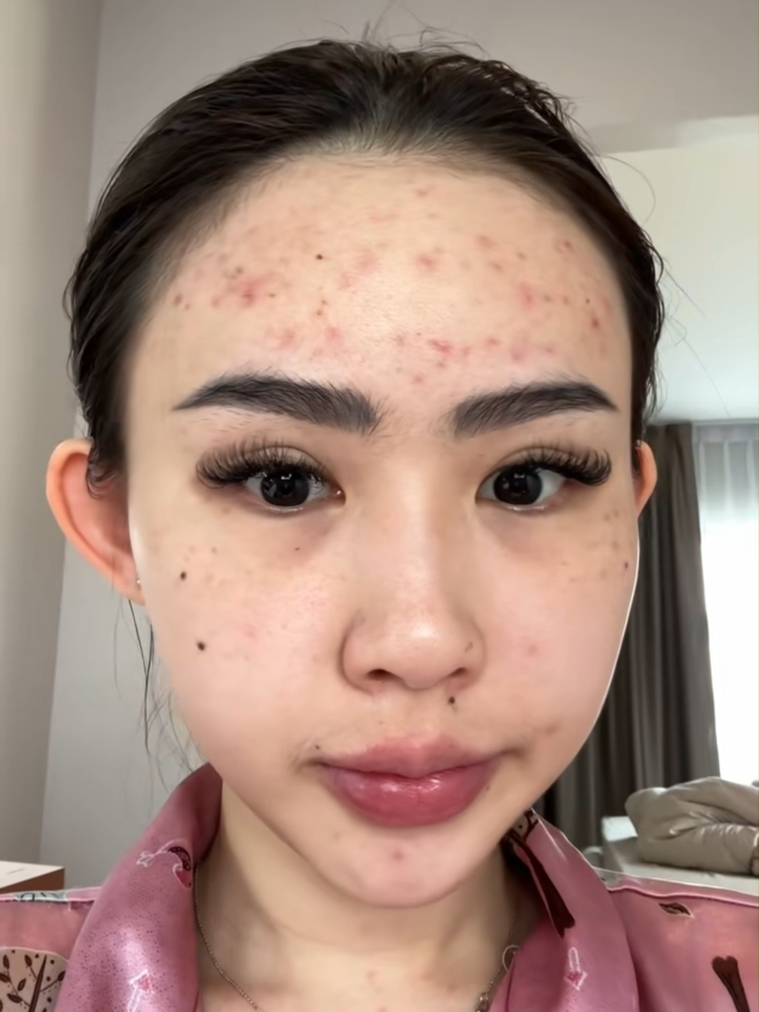 Kemerahan Mereda! #drfaycream #drfay #bekasjerawat #bopeng #drfayoriginal #jerawat