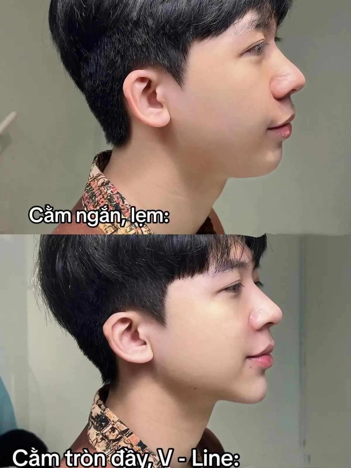 💉cằm để gương mặt cân đối, thon gọn sau 20phút #vaial #ilovetiktok #xh #thẩmmỹ 
