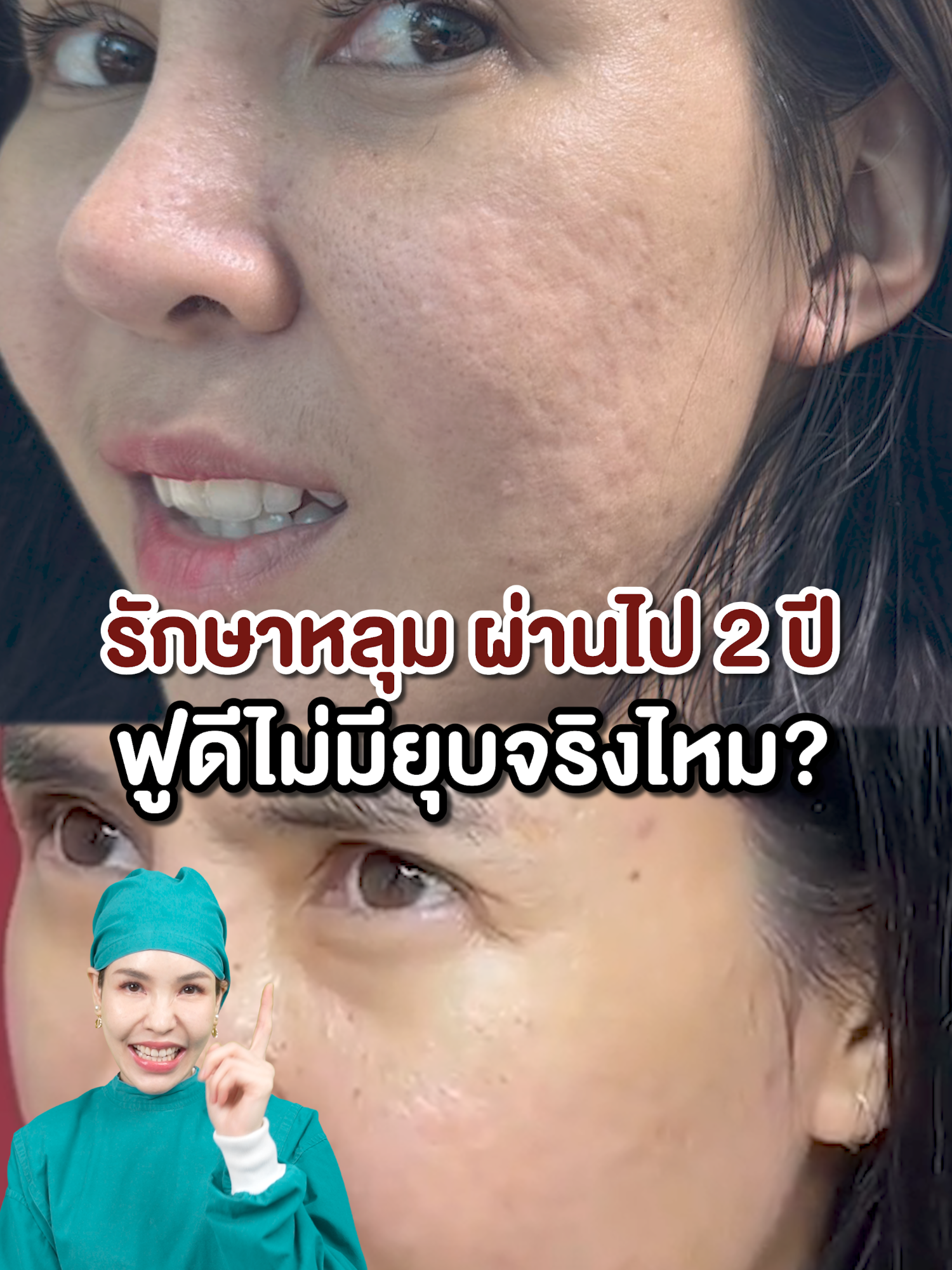 รักษาหลุมผ่านไป ฟูดีไม่มียุบจริงไหม? #doctornatclinic #รีวิวเคสจริงdrnat #หลุมสิว #รักษาหลุม #รักษาหลุมที่หน้า #หมอแนทรักษาหลุม #กวาดตัดพังผืดหลุมสิว #Subcision #เสียงพังผืด #MASS #เลเซอร์หลุมสิว