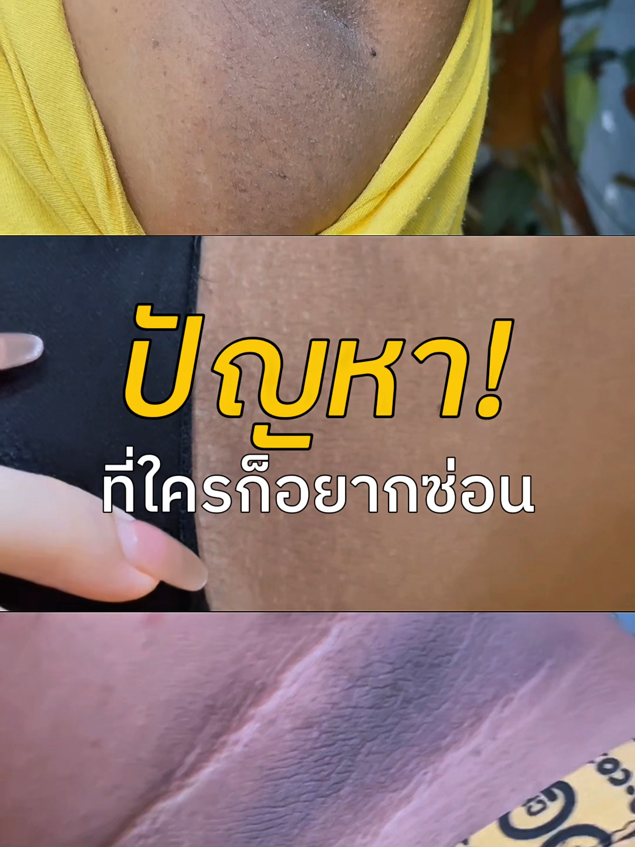 รักแร้ดำ หลังคลอด หรือจากกรรมพันธุ์ก็หายได้ แค่ลองเปิดใจใช้ครีมรักแร้ตัวนี้🤰 #รักแร้ขาว #รักแร้ดำ #คุณแม่ #แม่ลูก #ลูก