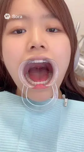 #口内#口内検査#口蓋垂#ホワイトニング#舌