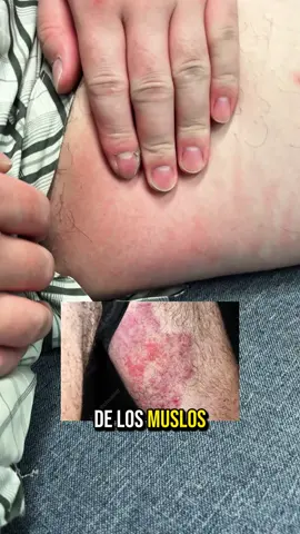 ¡La razón por la que tu sarpullido en la ingle sigue regresando podría ser esta!22 #fungalinfection #groinrash #itchrelief #groinitch #tiktokmademebuyit 
