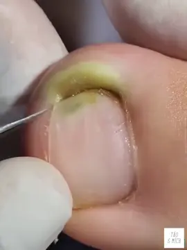 LẤY KHÓE SIÊU PHÊ MỜI CẢ NHÀ CÙNG XEM, NHẮN TIN EM ĐỂ EM TƯ VẤN BỘ LÀM MÓNG LẤY KHÓE , NÂM MÓNG DƯỠNG MÓNG . #laykhoe #laykhoemong #laykhoemongchan #laykhoechan #laykhoeda