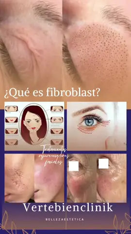 Plasma fibroblast ya sabes que es ? Es una técnica avanzada de Cosmetologa aparatologia . Nos ayuda a mejorar progresivamente signos de envejecimiento dando luminosidad colágeno elastina a nuestra piel .  Tenemos ofertas ! Anímate y contáctame 3114579201 Pereira local centro 6ta 