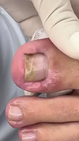 #nailsartvideos #unhaencravada #fyy #ingrowntoenail #podologia 