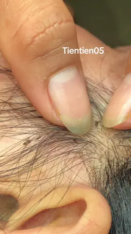 Remove lice 