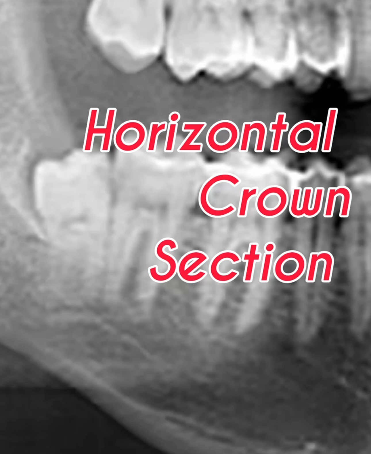 A really inflammed distoangular one. #distoangular #impactedwisdomtooth #wisdomteeth #wisdomteethremoval 