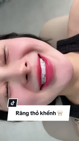 Chiếc Răng thỏ khểnh trong veo nhà Han này xứng đáng mấy điểm ạ 🦷🤍 #HanDental 
