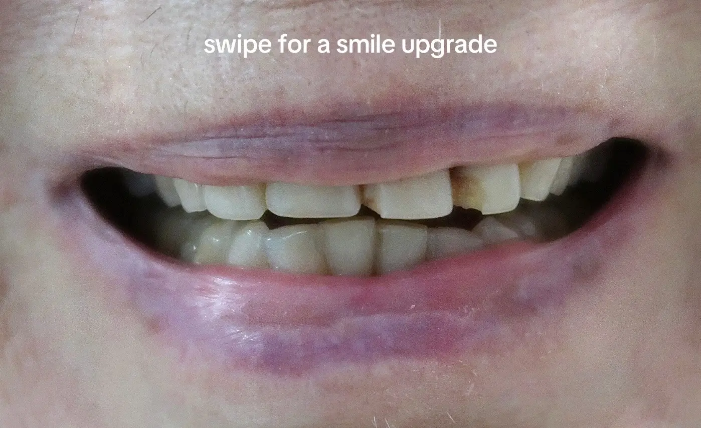 10 beautiful porcelain veneers to revive 30 year old dental work ✨ #veneers #cosmeticdentistry #orangecountyveneers #dentist #smiletransformation 