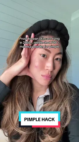 from deep cystic to flat within 24 hours. I think I’m onto something… reedle shot 700 + madeca powder > let that get tacky and dry > throw on easyderm EGF pimple patch and leave it on for 12 hours. #koreanskincare #kbeauty #skinhacks #pimplepatch 