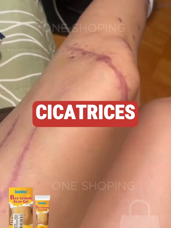 Elimina estrías y cicatrices en casa, fácil y sin dolor con Bee Venom Scar Gel - realizamos envíos gratis a todo el Perú Haz tu pedido por WhatsApp al # 900 137 254 #cicatriz #estrias