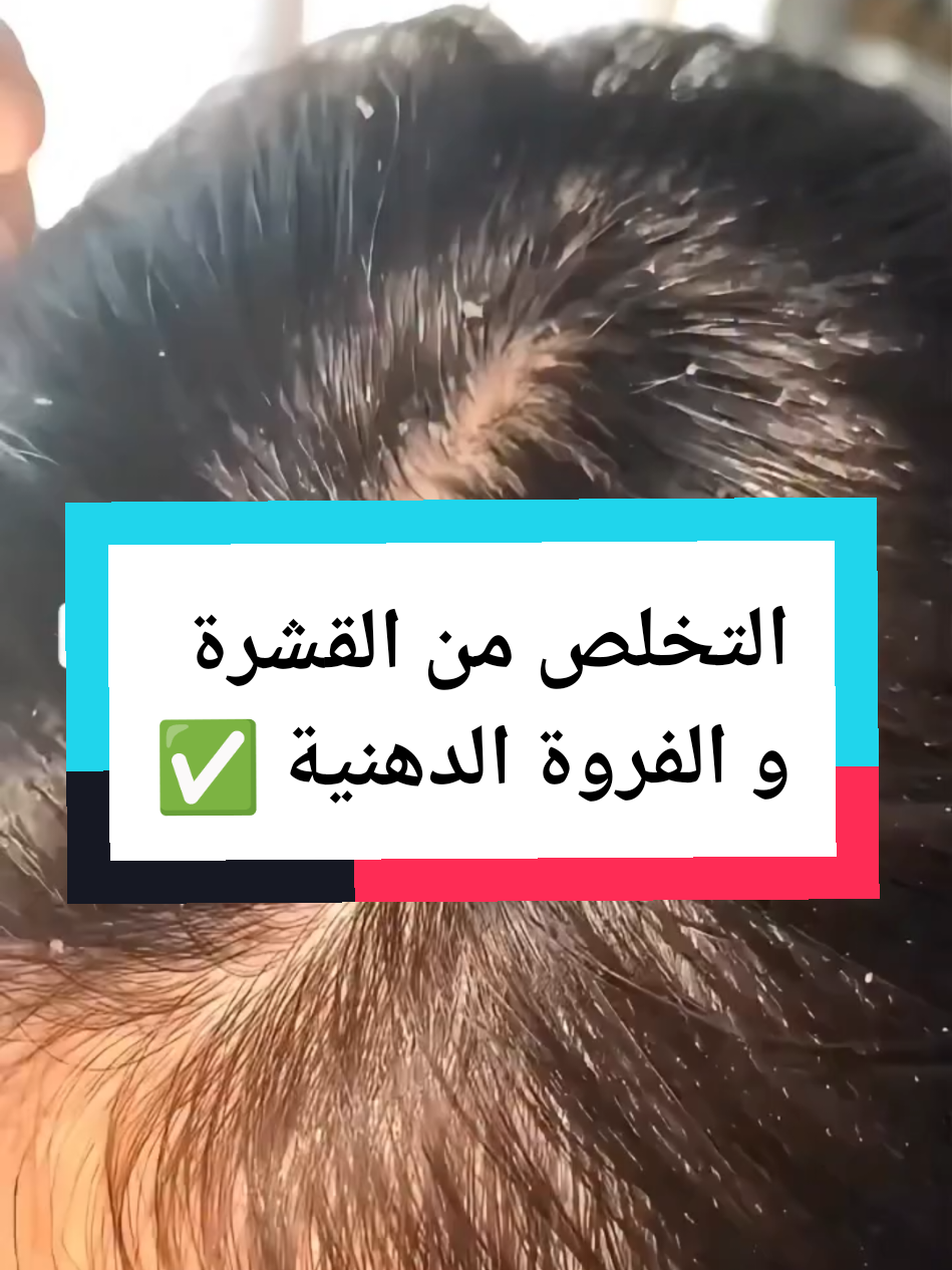 تخلصي من القشرة و الفروة الدهنية بغسلة وحدة 🧴✨ #fyp #اكسبلور #قشرة_الرأس #فروة_دهنية #شعر_دهني 