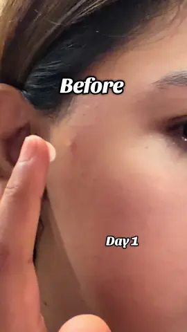 Healed my acne and acne marks like a magic in just 7 days ✨ #draltheabloomers #dralthea #345cream #acnetreatment #realpostacnecream @Dr.Althea US 