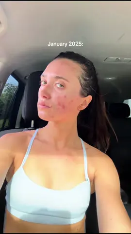 AH. Guys 6 months of microneedling - I cannot believe all the progress my skin has made - I’m so grateful!!!