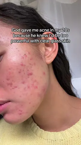 Hopefully it clears up with the 3 medications I’m on #acnetreatment #breakouts #acneproneskin #sensitiveskin 