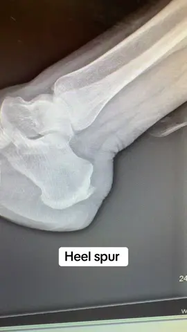 This is a heel spur x-ray, finding on a patient who presented with back of heel pain and Achilles tendinitis. First line of treatment is to massage, stretch and ice the area. It’s also recommended to replace old, thin, flat, worn out shoes.  Avoid walking barefoot. Sometimes injections and anti-inflammatories are prescribed for this condition as well as physical therapy.  #achilles #tendinitis  # xray #heelpain 👩🏻‍⚕️🦶🏼 #group7 