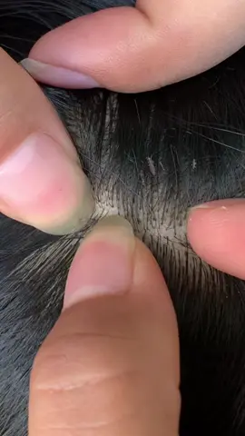 😱😱😱#omg #lice #liceremoval 