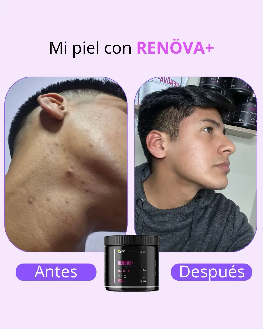 Renöva+ es mucho más que colágeno 💜 Contiene Resveratrol, que mejora la elasticidad, firmeza y brillo natural de tu piel, ayudando a reducir rojeces y calmar la sensibilidad. La Coenzima Q10 potencia la hidratación y mantiene tu piel más suave, fresca y luminosa. 🔹 Resultados visibles. 🔹 Fórmula premium sin azúcar ni grasas. 🔹 Ideal para piel, uñas, cabello y articulaciones. 💫 Empieza tu cambio hoy con Renöva+, la dosis diaria de juventud que tu cuerpo necesita. 📩 Escríbeme al DM para más info o para hacer tu pedido. #colageno #bienestar #resveratrol🍇 #alexseyvargas #salud 