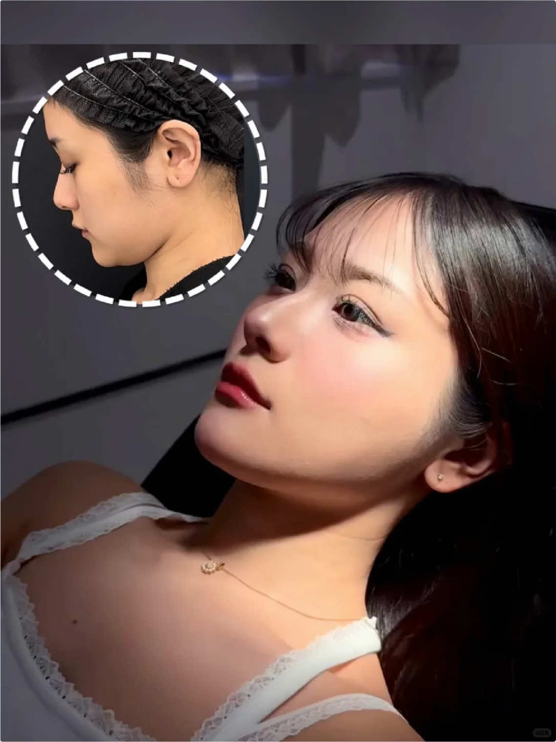 Firming the face and enhancing the small V face#fyp #VShapeFace #DefinedJawline #ChinTightening #SnatchedJawline
