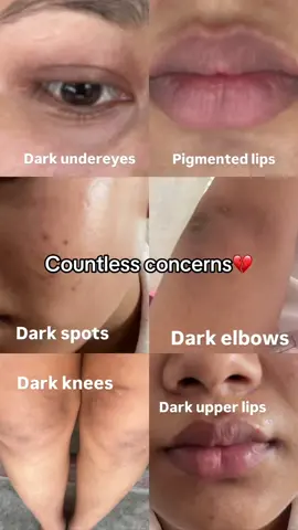 One product that can solve all skin concerns❤️‍🩹use KSECRET SEOUL1988 eye cream ✨@KSECRET GLOBAL #KSECRETGlowChallenge #KSECRET #seoul1988 #hyperpigmentation #darkspots 