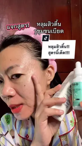 หลุมสิวตื้น สิวไม่ขึ้น รูขุมขนกว้าง กลับมาเบียด กระชับ ใช้ proacno ของยันฮี เช้าเย็น ใช้ เรตินอล ตึงนอล Nectapharma  ก่อนนอน #หลุมสิว #หลุมสิวตื้นขึ้น #สิว #บํารุงผิว 