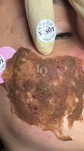 Bóc sẹo #chamsocdamun#chamsocdaseo#chamsocdanam#tanbinh#Lqspa&academy