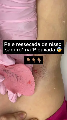 E por isso que é bastante importante sempre manter a pele hidratada!!!   Veja o que acontece nesse procedimento 👇🏽😥 #fyp #wax #challenge #esthetician #trending         