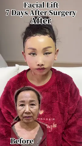 55-year-old face lift#Facelift #FaceLifting #facelift #faciallifting #beauty 