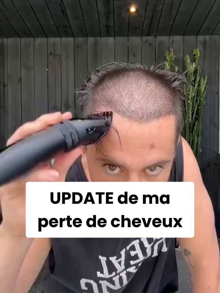 Tu pensais que c’était foutu ? Regarde ça. 👇 (LIEN EN BIO) #cheveux #calvitie #poussedecheveux #hairregrowth #hairregrowthtreatment #hairloss #pertedecheveux