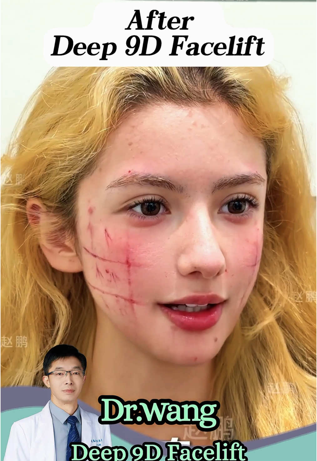 ✨ “Ten years in China taught me many things — but I almost forgot how to love my own reflection.” ✨ This 40-year-old Chinese-Russian lady 🇨🇳🇷🇺 has lived in Shanghai for over a decade. Busy with work, adapting to a new life, she gradually noticed her once-bright features becoming tired and less defined. After meeting Dr. Wang, she decided on a Deep 9D Facelift — a precise, professional technique that works on deeper facial layers to restore firmness and harmony. The result: a naturally lifted, youthful look that feels authentic — like herself again, only brighter. 🌸 💬 “It’s not about chasing perfection — it’s about finding my own light again.” 📍 Deep 9D Facelift by Dr. Wang, Shanghai, China #Deep9DFacelift #FaceArtMed #DrWang #ShanghaiBeauty #NaturalLift #FacialRejuvenation #ConfidenceRenewal #HybridBeauty #GracefulAging #AuthenticElegance #ProfessionalCare #beautyjourney 