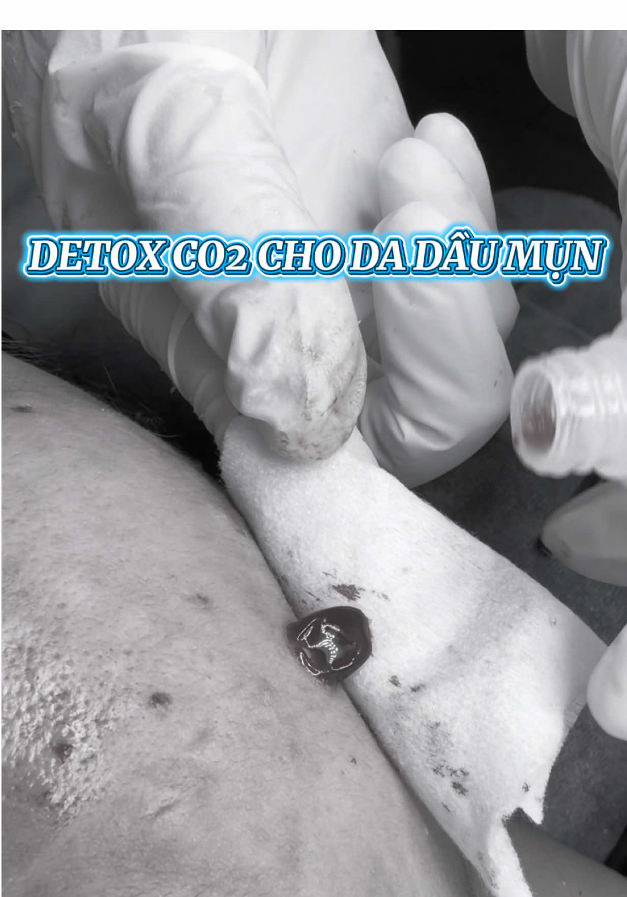 𝐓𝐇Ả𝐈 ĐỘ𝐂 𝐂𝐎𝟐 - 𝐓𝐇𝐀𝐍𝐇 𝐋Ọ𝐂 𝐃𝐀 𝐓Ầ𝐍𝐆 𝐒Â𝐔  Không nói nhiều với best seller em này  Detox Co2 thải sạch độc tố, dầu thừa, bụi bẩn bám lỗ chân lông. #thanhlocda #spa #govap #co2   🔛 Khách bị mụn do độc tố, mụn viêm nặng, mụn ẩn thì nên đki gói nặn mụn thải độc C02.  🔛  Da nhiễm corticoid  👉🏻  KỂ CẢ DA THƯỜNG VẪN NÊN THẢI ĐỘC