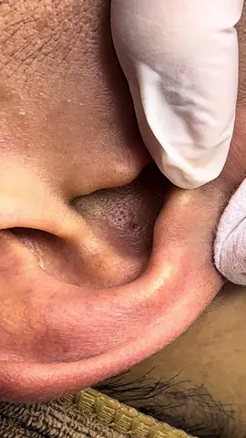 Mụn chân sâu #mụntai #lấymụnbằngnhíp #mụn #ilovetiktok❤️ #mụnchânsâu 