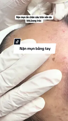 Nặn mụn ẩn trên nền da khô ,bong tróc #nặnmụnbằngtay #peeldachuanykhoa #fyb #hoàngquốcviệt 
