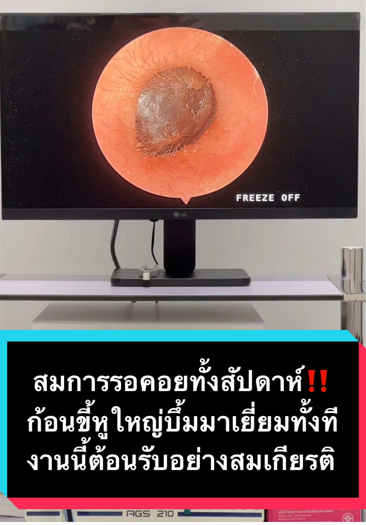ก้อนระดับบิ๊กมาเยี่ยมถึงคลินิก งานนี้จัดเต็มกันเลยจ้ะ #พี่หมอเปย่าหูคอจมูก #tiktokuni #earwax #ขี้หู #หูอื้อ 