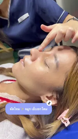 เสริมจมูก เซมิโอเพ่น เย็บยกโดม