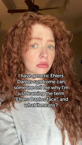 Hi friends, what is Ehlers Danlos face?