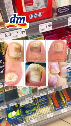 Einfache Masken zur Behandlung von Nagelpilz#nagelpilz #nail #nailfungus #fyp #body 