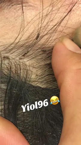 Remove lice #omg🙀🙀🥶🥶🥶😱❤️❤️ #lice #liceremoval 