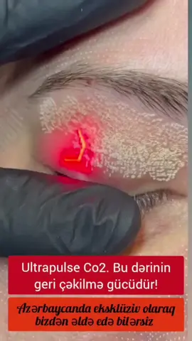 Ultrapulse-CO2 FDA təsdiqli fraksional lazer cihazı. 2025 ci ilin istehsalı Ultrapuls-CO2 Fraksional lazer cihazı. Cihazın ürəyi sayılan lazer generator Amerikanın Coherent şirkətinə məxsus 40w və 60w gücündə olan RF metal tubedir. 20*20mm spot ölçüsündə olan skaner, və 50 və 100mm Kəsici başlıqları ilə bir fraksional lazer olaraq tamamilə təhlükəsiz və effektiv formada prosedurlarınızı həyata keçirə bilmək üçün ideal olaraq hazırlanmışdır. Aparatın komplektində mövcud olan iki ədəd 45, 90 və 360 dərəcəlik vaginal başlıqlarla intim bölgələrdə də həmçinin mükəmməl effekt əldə edə bilərsiniz. Cihazın istifadəsinə göstərişlər: Lazer cavanlaşdırma (şlifovka) Piqment ləkələri: Yaş ləkələri, xal ləkələri, günəş ləkələri Göz ətrafı qırışlar Akne və Postakne Cərrahi çapıqlar Melazma Striya və Dəri çatları Keratozlar Sidik qaçırma Ziyillər Mazollar Ət xallarının götürülməsi Vaginal cavanlaşma Labioağartma Estetik ginekoloji prosedurlar İntim məmnuniyyətin sağlanması və problemlərin aradan qaldırılması Yaranın yaxşılaşması (hipertrofik iz) və yaradan qaynaqlanan qabarmaların (keloid) azaldılması Piyogenik qranülomanın müalicəsi Cihazı əldə etmək istəyirsinizsə bizimlə əlaqə saxlayın: Tel/Whatsapp 📳 070 265 55 54 #fraksionallazer #co2lazeraparatı #co2fraksionallazer #lazerprosedurları #lazeraparatları 