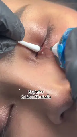 สิวหัวข้าว#รับจี้สิวหัวข้าว#กระเนื้อ#สิวหิน
