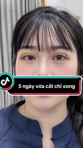 Mắt 2 mí 5 ngày  mà tui vừa cắt chỉ xong nè các bạn #bắcninh #cắtmí #kcnvsipbắcninh #mắthaimí 