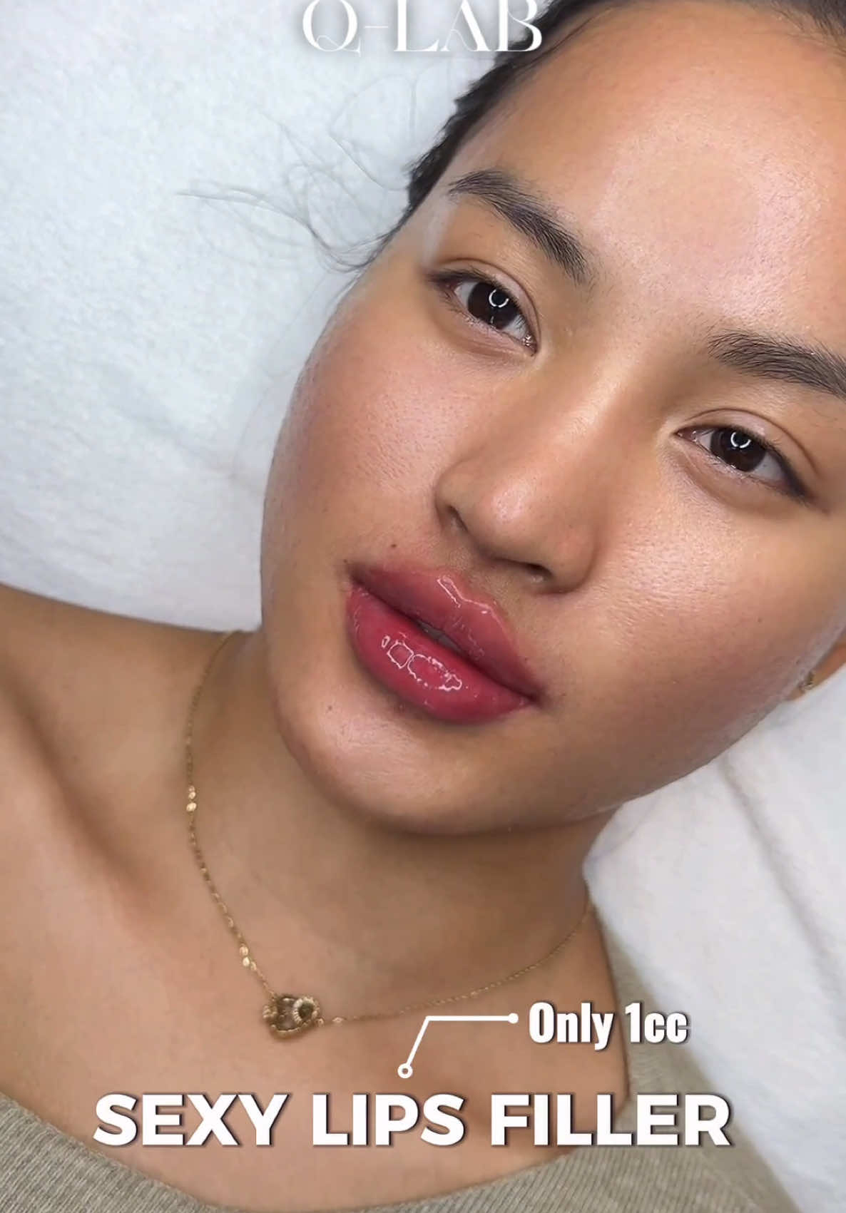 Sexy lips                                                  #xuhuongtiktok #qlab #qlabbeauty #tiemmoi #filler 