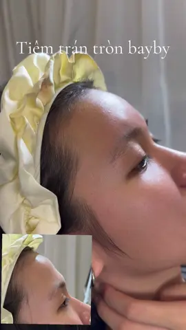 Tiêm lõm trán, tạo khuôn trán tròn bayby làm đường nét khuôn mặt sáng và mềm mại  #filler #botox #beauty #lamdep #xh 